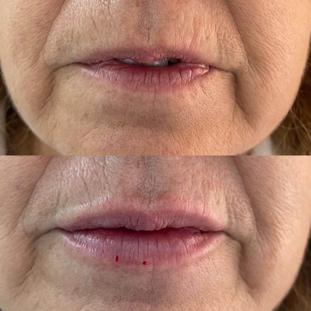 medicina estetiva-relleno de lavios y ojeras-rinomodelacion-eliminacion de arrugas-doctora gilene duran_17